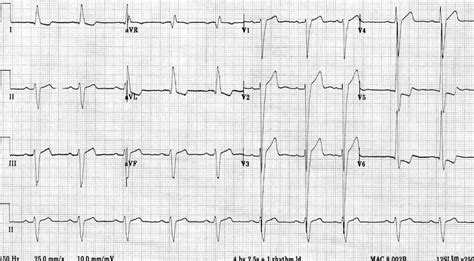 Electrocardiograma Hipertrofia Ventricular Izquierda The Best Porn