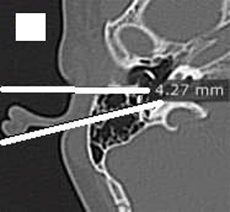 An axial cut of right temporal bone HRCT, showing the distance between ...