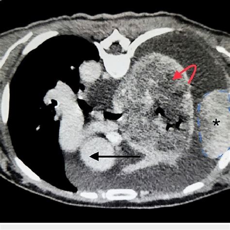 Computed Tomography Ct Of Chest With Contrast Axial View Showing Download Scientific