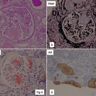 Light Microscopic Findings Of The First Renal Biopsy Specimen Of Case