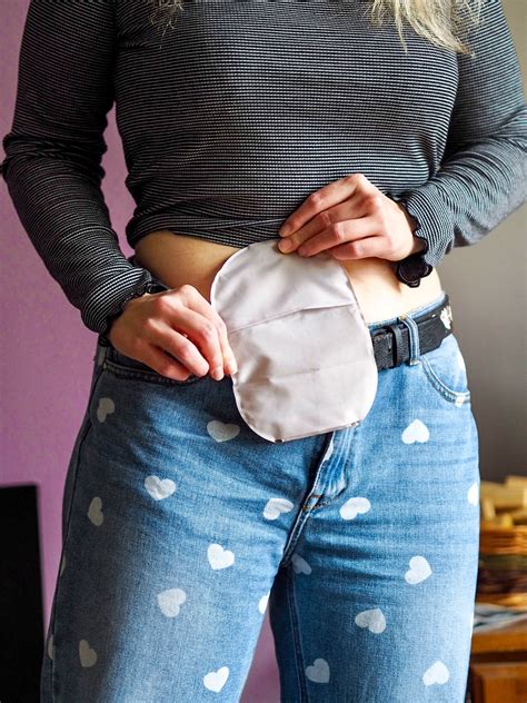 Stoma Facts Debunking Common Myths About Ostomy Life