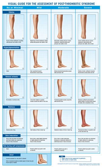 Jcm Free Full Text Prevention And Management Of The Post Thrombotic Syndrome