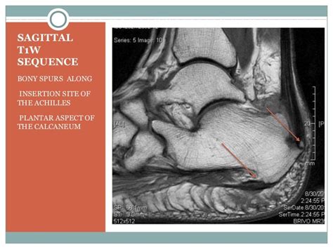 Haglunds Deformity