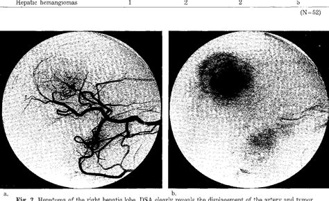 Figure From Intraarterial Digital Subtraction Angiography For