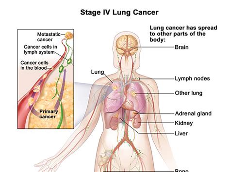 First-Line Immunotherapy Treatment Can Improve Survival for Subset of ...