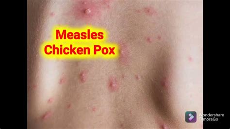 Measles And Chicken Pox Differences Youtube