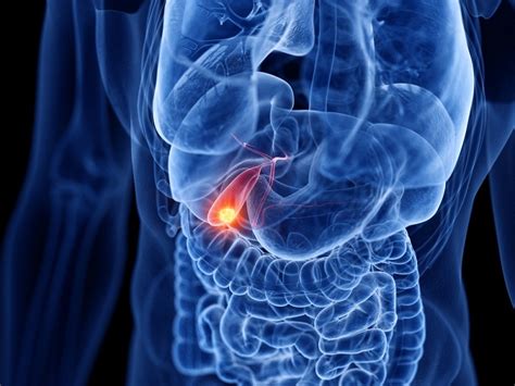 पित्ताशय का कैंसर के कारण लक्षण इलाज और बचाव Gallbladder Cancer