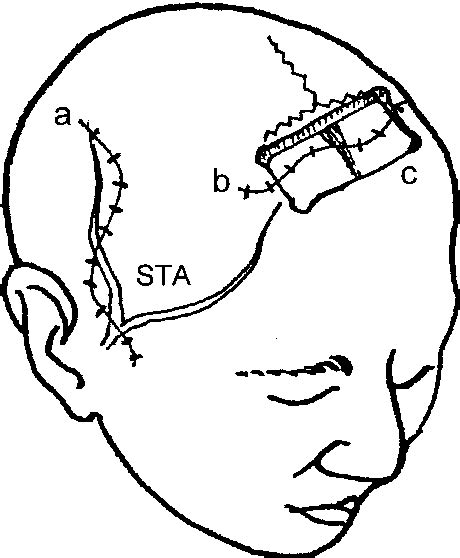 Craniotomy For Craniosynostosis Bifrontal Bone Flap Semantic Scholar