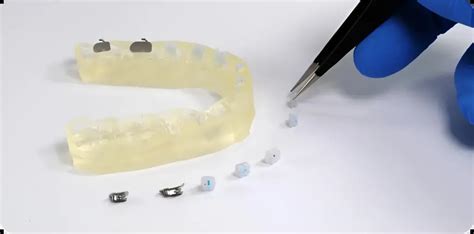 Appareils Multi Attaches Orthodontie Du Dr Ohayon Strasbourg