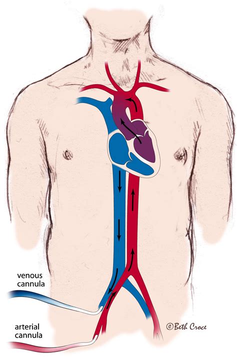 Review Of Ecmo Extra Corporeal Membrane Oxygenation Support In