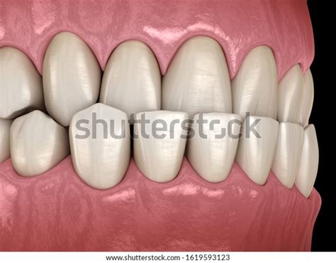 Underbite Dental Occlusion Malocclusion Teeth Medically Stock