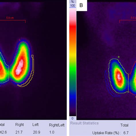 Thyroid Uptake Patient S First Thyroid Scan A Showed Diffuse Goiter