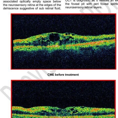 Cystoid macular oedema | Download Scientific Diagram