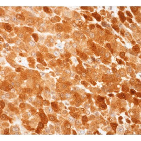 Immunohistochemical Features Of The Tumor Cells The Tumor Cells Showed