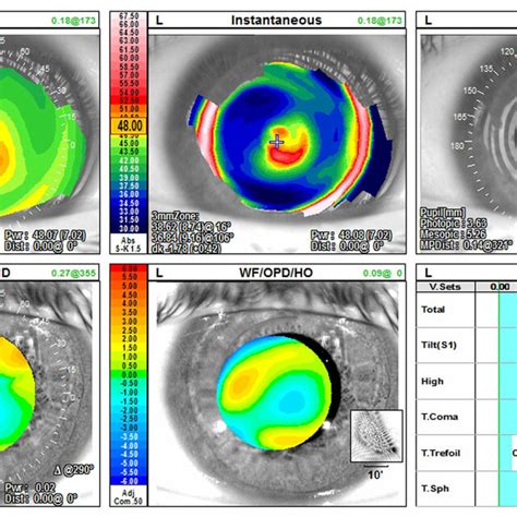 Corneal Topography 7 Months After Collagen Crosslinking In The Left Eye