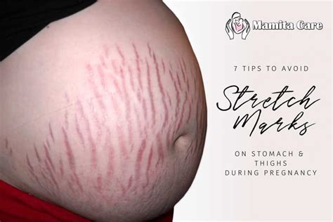 7 Tips To Avoid Stretch Marks On Stomach And Thighs During Pregnancy