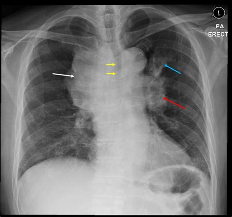 Mediastinal lymphadenopathies: lung adenocarcinoma – Radiology Cases