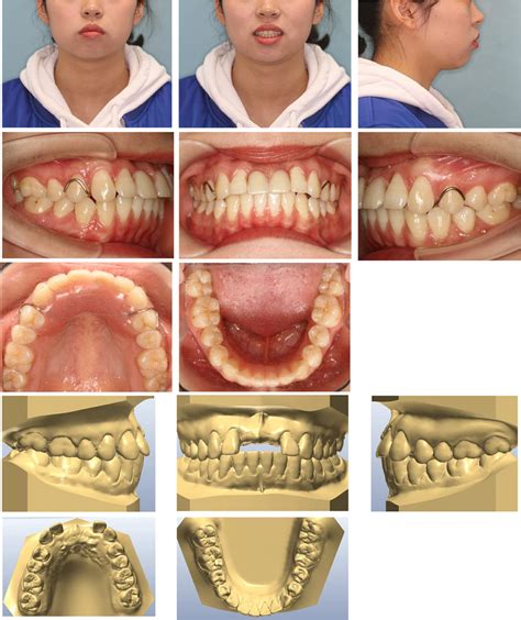 Pretreatment Facial And Intraoral Photographs And Dental Casts