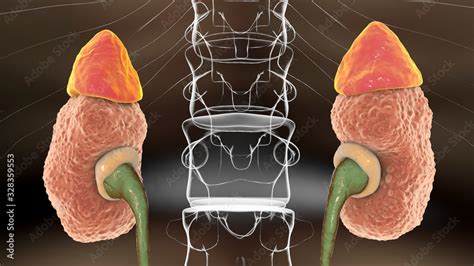 Chronic glomerulonephritis, gross pathology Stock Illustration | Adobe Stock