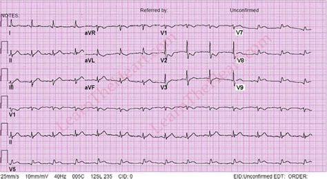 Posterior Wall MI - Posterior ECG | LearntheHeart.com