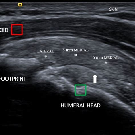 Greyscale Ultrasound Of A Repaired Supraspinatus Tendon In The