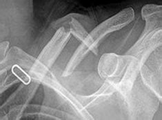 Broken Collarbone Sydney | Clavicle Fracture Randwick