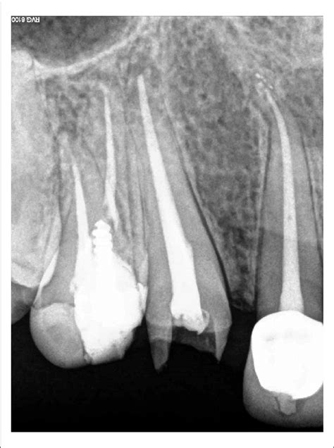 Final root canal obturation. | Download Scientific Diagram