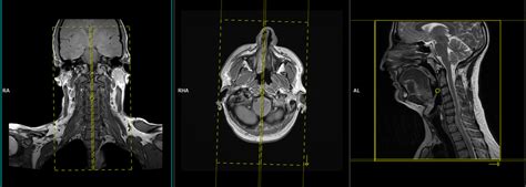 MRI soft tissue neck planning and protocols | Indications for MRI neck scan