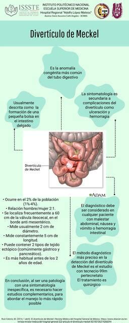 Divert Culo De Meckel Cath Cathi Udocz