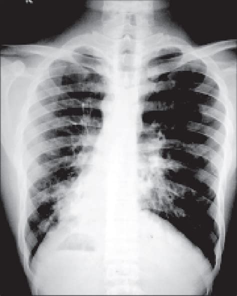 Chest Xray Pa View Showing Dextrocardia Fundal Gas Shadow On The Right