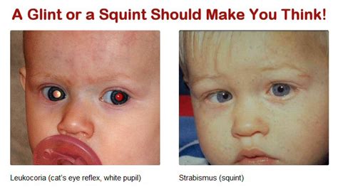 Signs and Symptoms of Retinoblastoma - WE C Hope