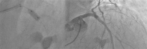 Hybrid Revascularization In Patient With Nstemi