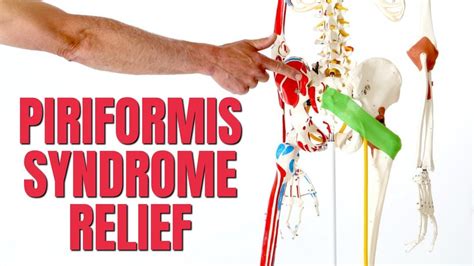 Tight Piriformis Syndrome Pinched Nerve Relief 5 At Home Treatments