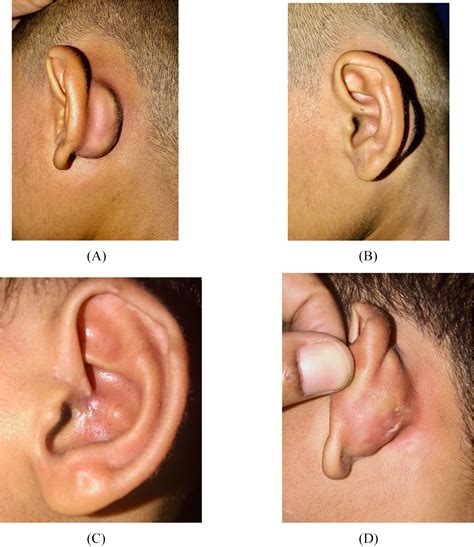 The Variant Type Of Preauricular Sinus With Recurrent Postauricular