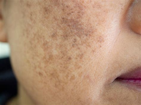 Pigmentation Spots On Face