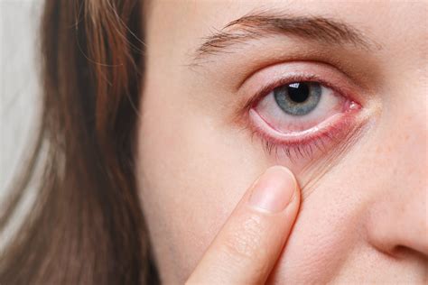 How To Prevent Blepharitis Sunnyside Ny