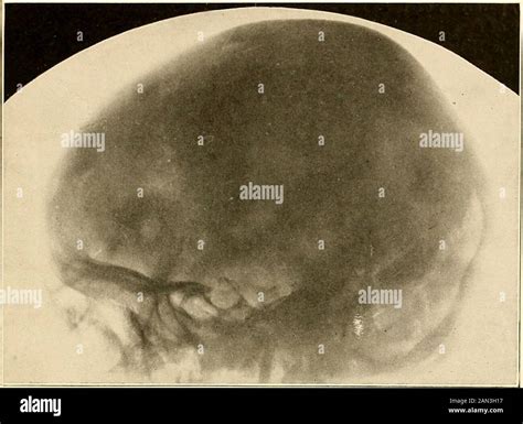 Roentgen Diagnosis Of Diseases Of The Head Acusticus Tumor With