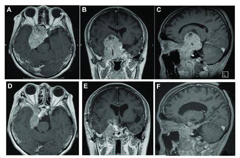 AeC Results Of Brain Magnetic Resonance Imaging With Gadolinium On