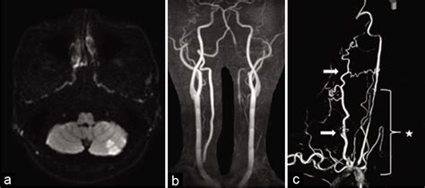 V3 Segment Vertebral Artery