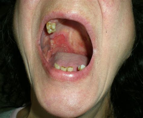 Squamous Cell Carcinoma Cheek