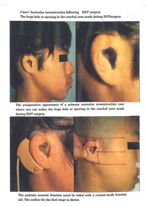 Auricular Reconstruction Following Ent Surgerynagata Microtia And