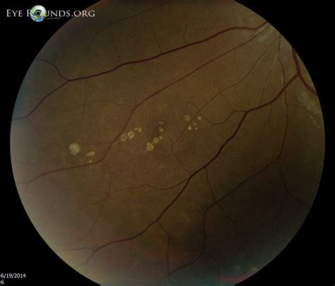 Atlas Entry - Grouped congenital albinotic spots of the retinal ...