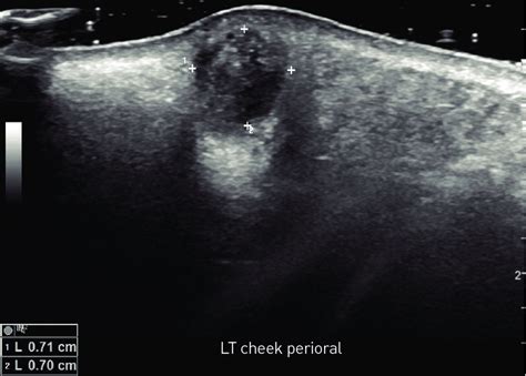 Facial Sonography Showing An Ill Defined Heterogeneously Hypoechoic