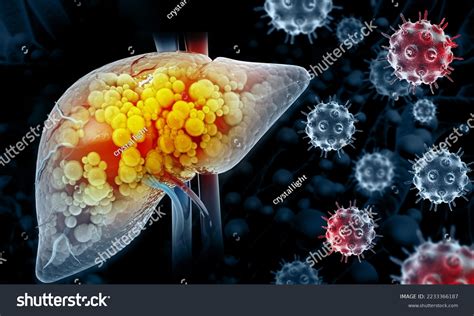 Liver Cancer Liver Tumor Hepatocellular Carcinoma Stock Illustration 2233366187 Shutterstock