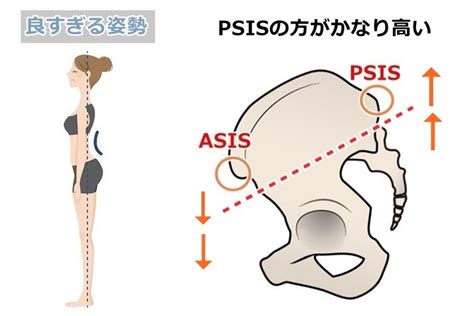 姿勢観察は身体の中心から！骨盤の傾きと股関節の関係を解説 びーせらぴすと