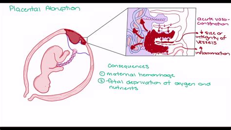 Pathophysiology Of Abruptio Placentae