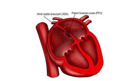 Patent Foramen Ovale Symptoms And Treatment Dr C Raghu