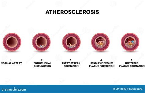 Atherosclerosis Plaque Development