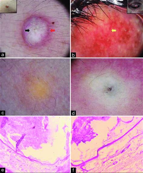 Dermoscopy of epidermal cyst shows pore sign (black arrow), ivory white ...