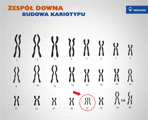 Zespół Downa trisomia 21 Przyczyny objawy i dziedziczenie